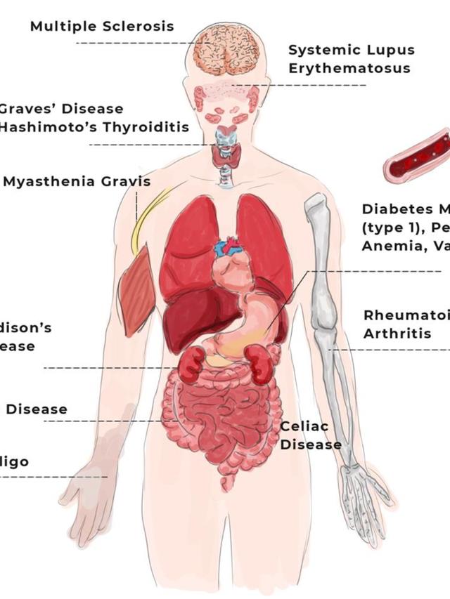 Recognizing Autoimmune Disorders